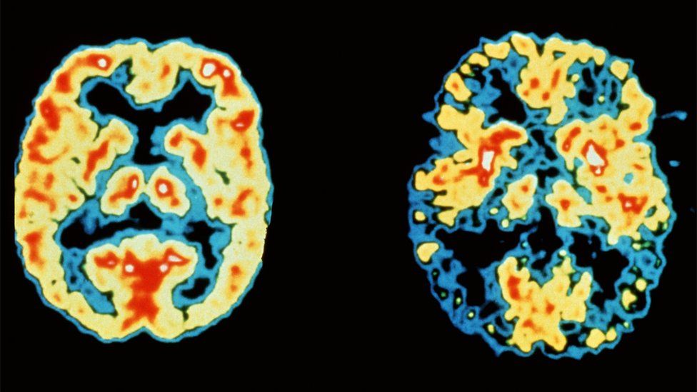 et røntgenbillede af hjerne med demens