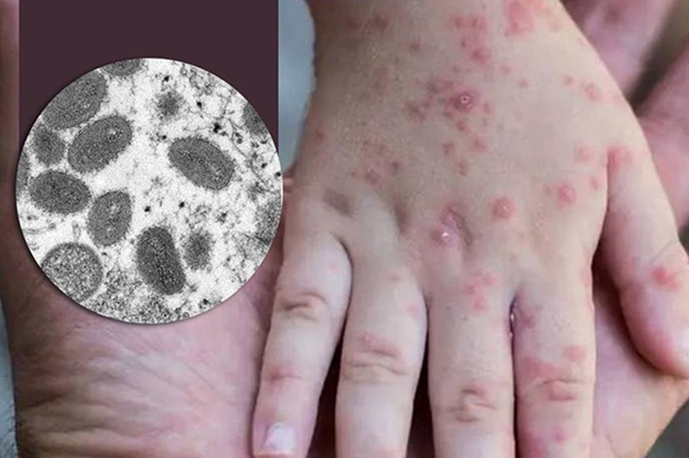 Monkeypox Virus Outbreak